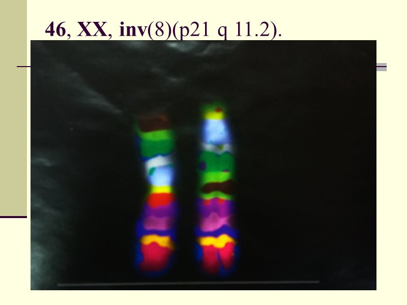 46,XY,t(13;14)  ● транслокации – перестройка двух хромосом с переносом участка одной хромо­сомы на